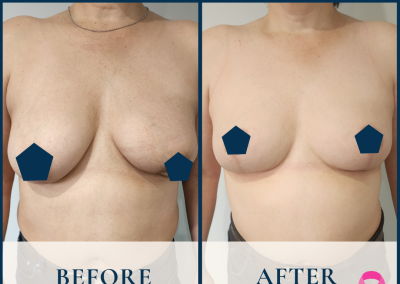 breast fat grafting sydney
