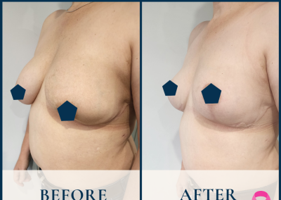 breast fat grafting sydney