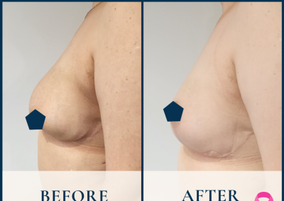 best breast fat grafting sydney