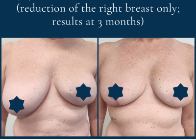 best surgeon for breast reduction in Sydney - Dr Vlad ILLIE