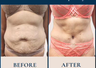 best abdominoplasty sydney