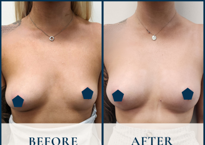 breast fat grafting sydney