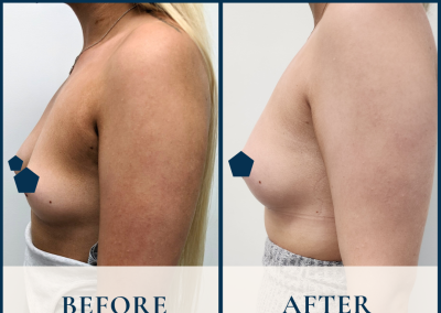 breast fat grafting sydney