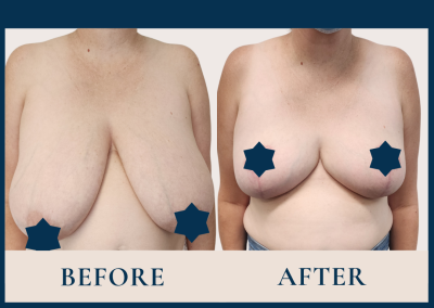 best breast reduction sydney - dr vlad illie