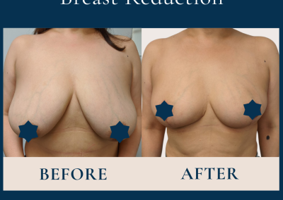breast reduction sydney
