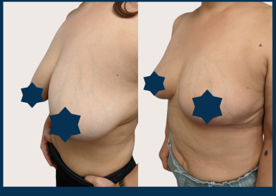 best breast reduction sydney