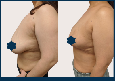 best breast reduction Sydney - Dr Vlad ILLIE