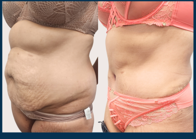 best radical abdominoplasty sydney