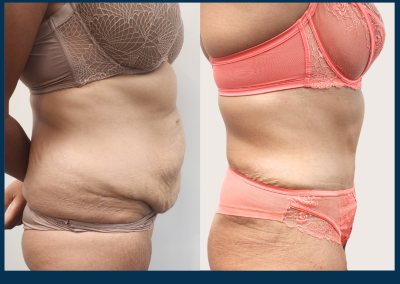 best radical abdominoplasty sydney