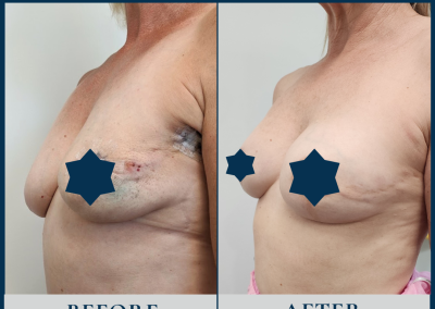 breast reconstruction sydney