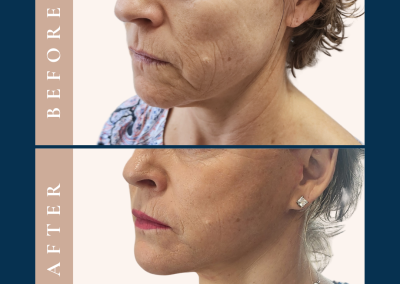 best deep plane face and neck lift in Sydney - Dr Vlad ILLIE