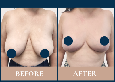 best breast reduction surgeon in Sydney - Dr Vlad ILLIE specialist plastic and reconstructive surgeon