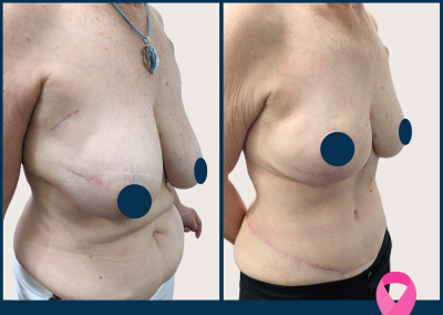 best breast reconstruction with DIEP free flap in Sydney - Dr Vlad ILLIE, specialist plastic and reconstructive surgeon, St Vincent's Hospital Sydney